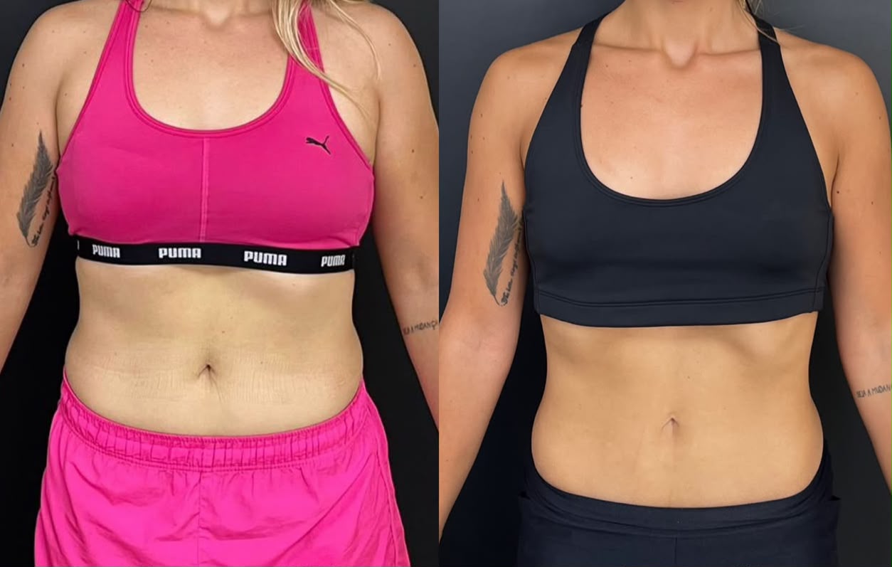 Registro de antes e depois de paciente em acompanhamento nutricional
