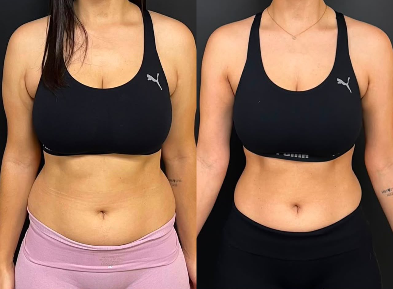 Registro de antes e depois de paciente em acompanhamento nutricional