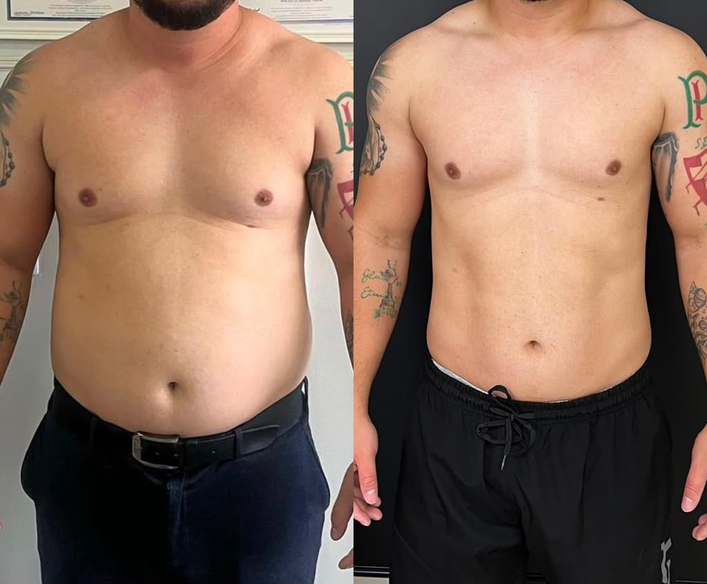 Registro de antes e depois de paciente em acompanhamento nutricional